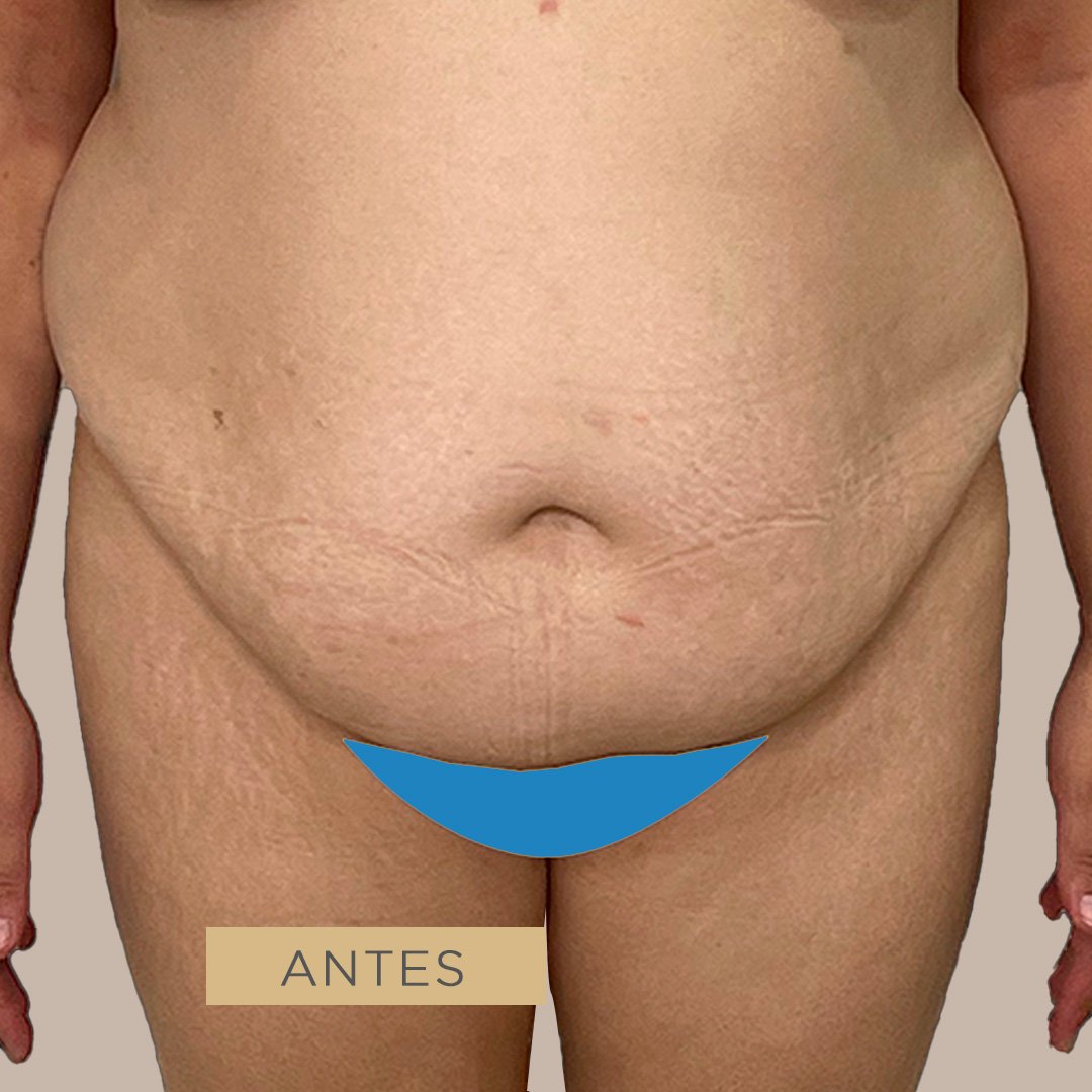 Fotos de Abdominoplastia antes