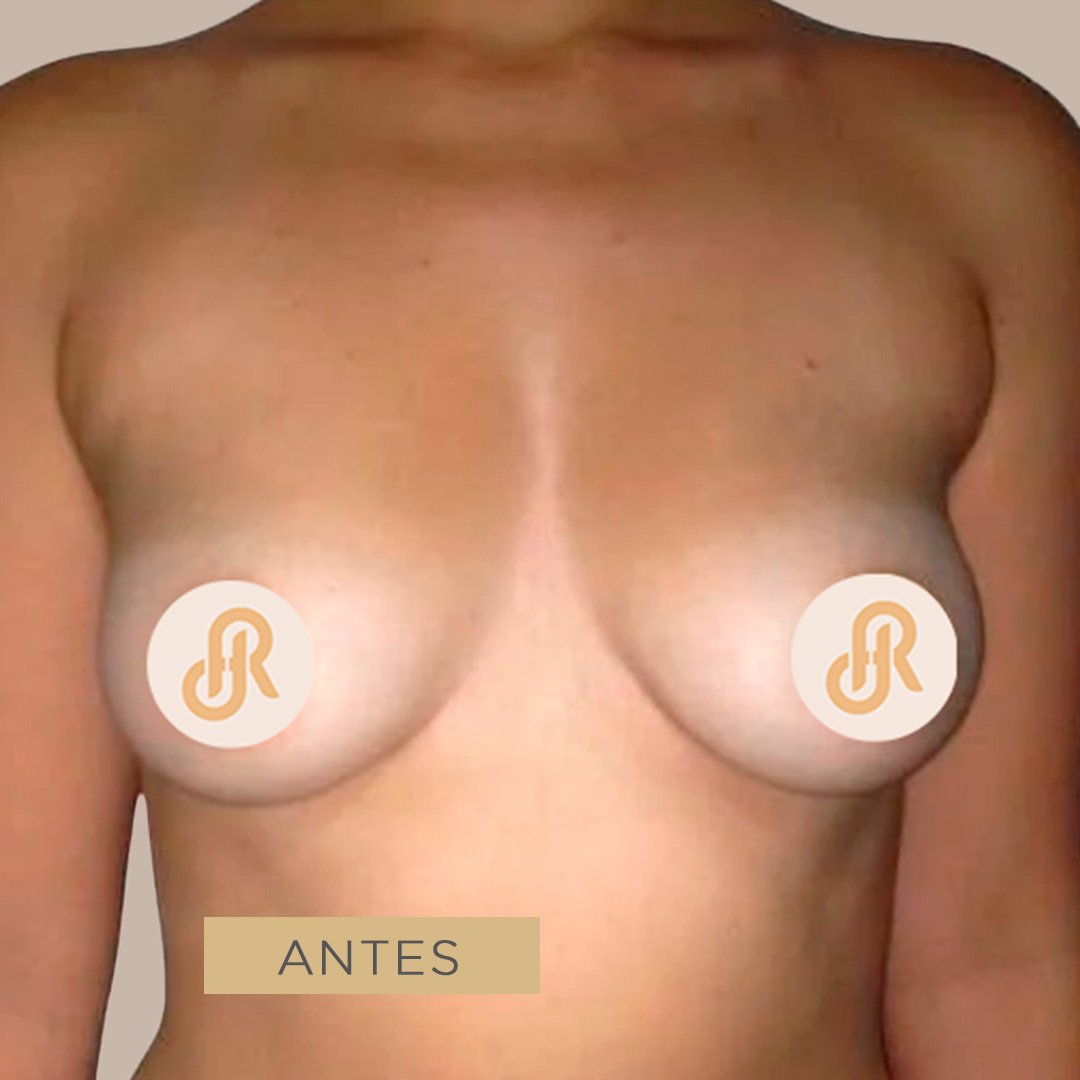Fotos de Aumento de Senos antes