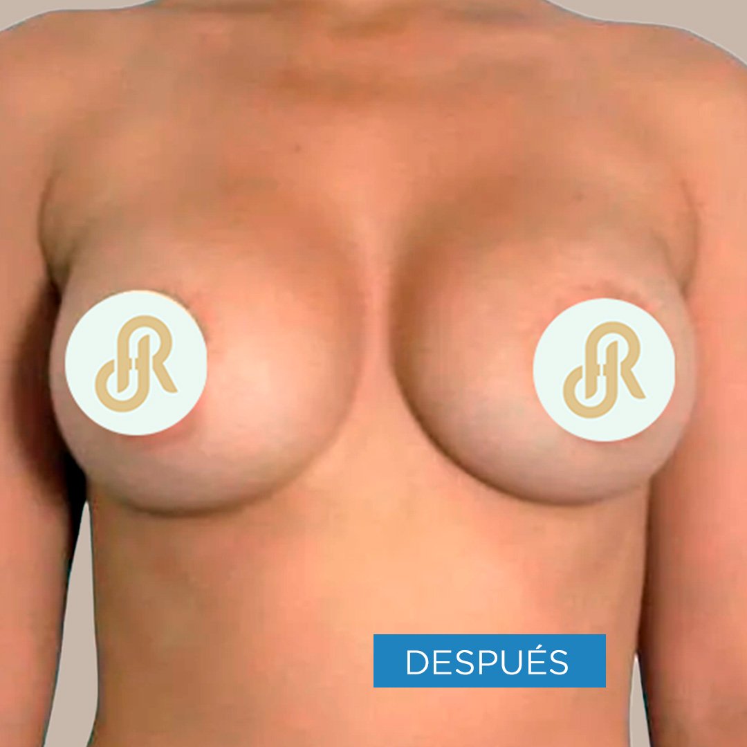 Fotos de Aumento de Senos después