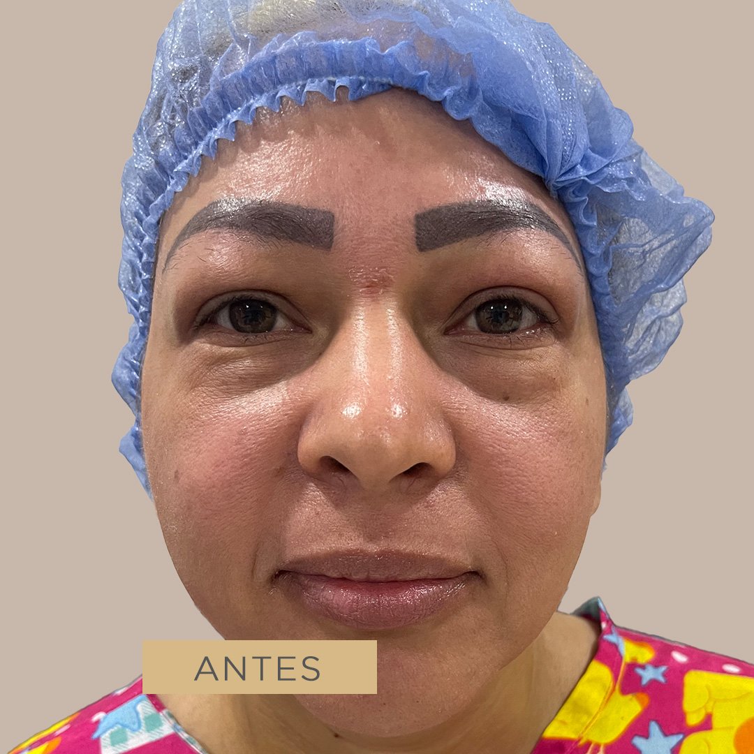 Fotos de Blefaroplastia antes