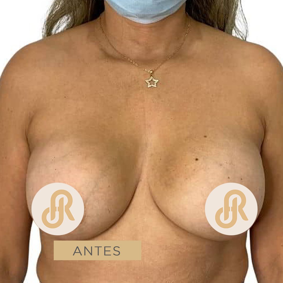 Fotos de Retiro o Explantación de Implantes Mamarios antes