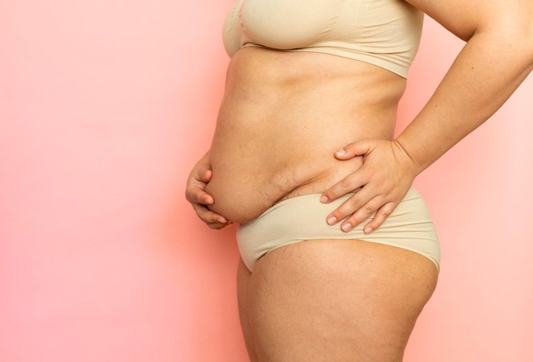 Abdominoplastia dra Damaris Romero