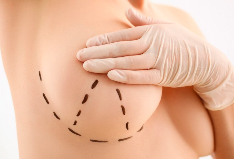 Levantamiento de Senos dra Damaris Romero