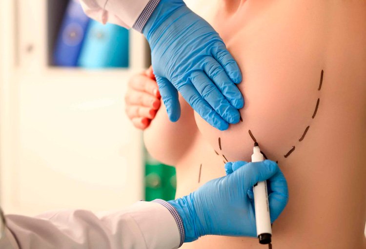 Levantamiento de Senos