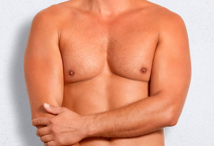 Ginecomastia, reducción de pechos en hombres Dra Damaris Romero