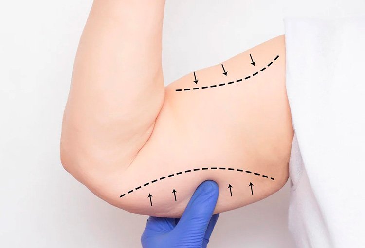 Estiramiento de brazos, braquioplastia