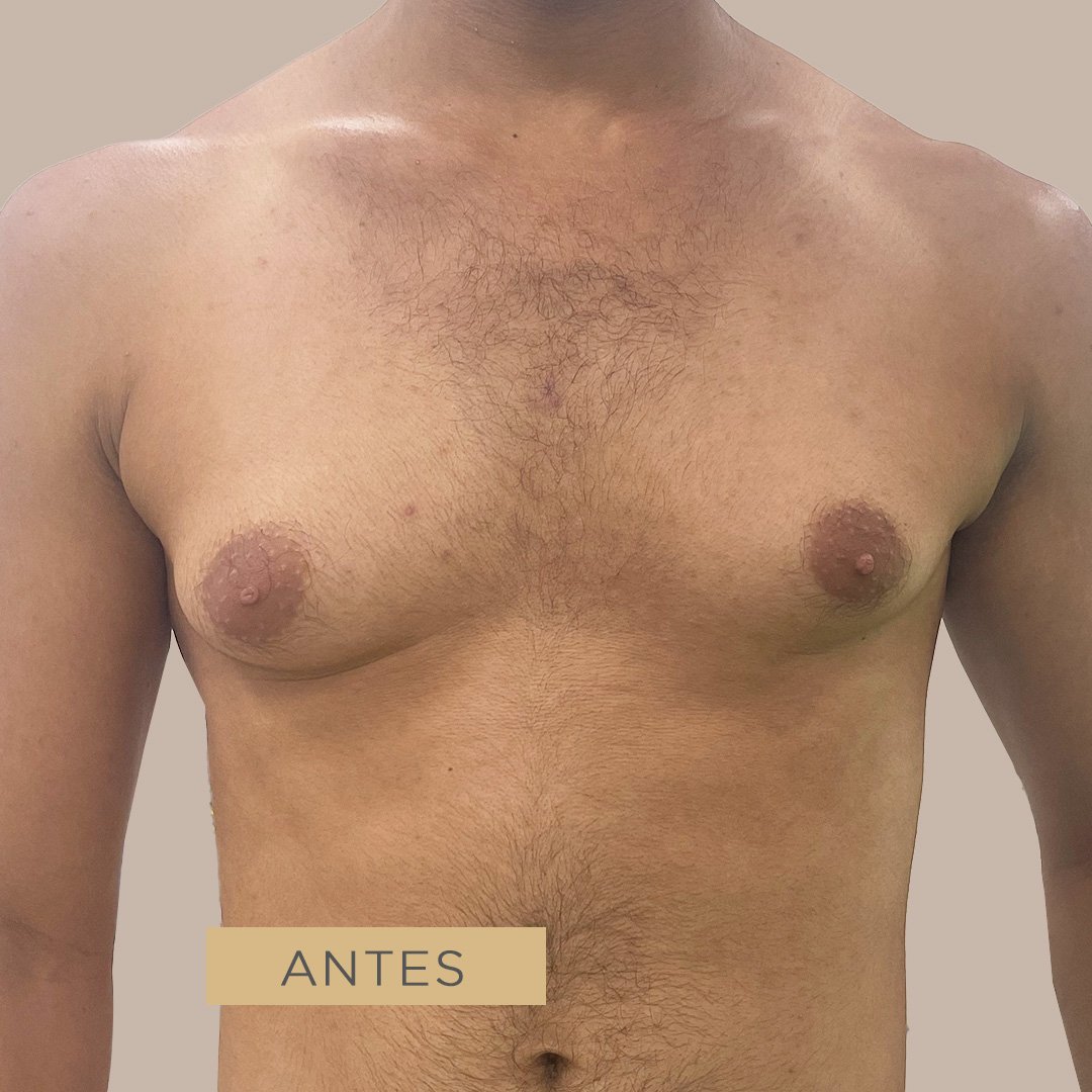 Fotos de Ginecomastia antes 2