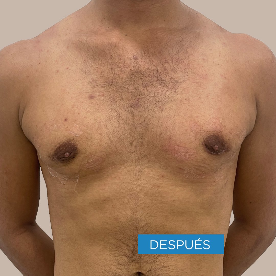 Fotos de Ginecomastia despues 2