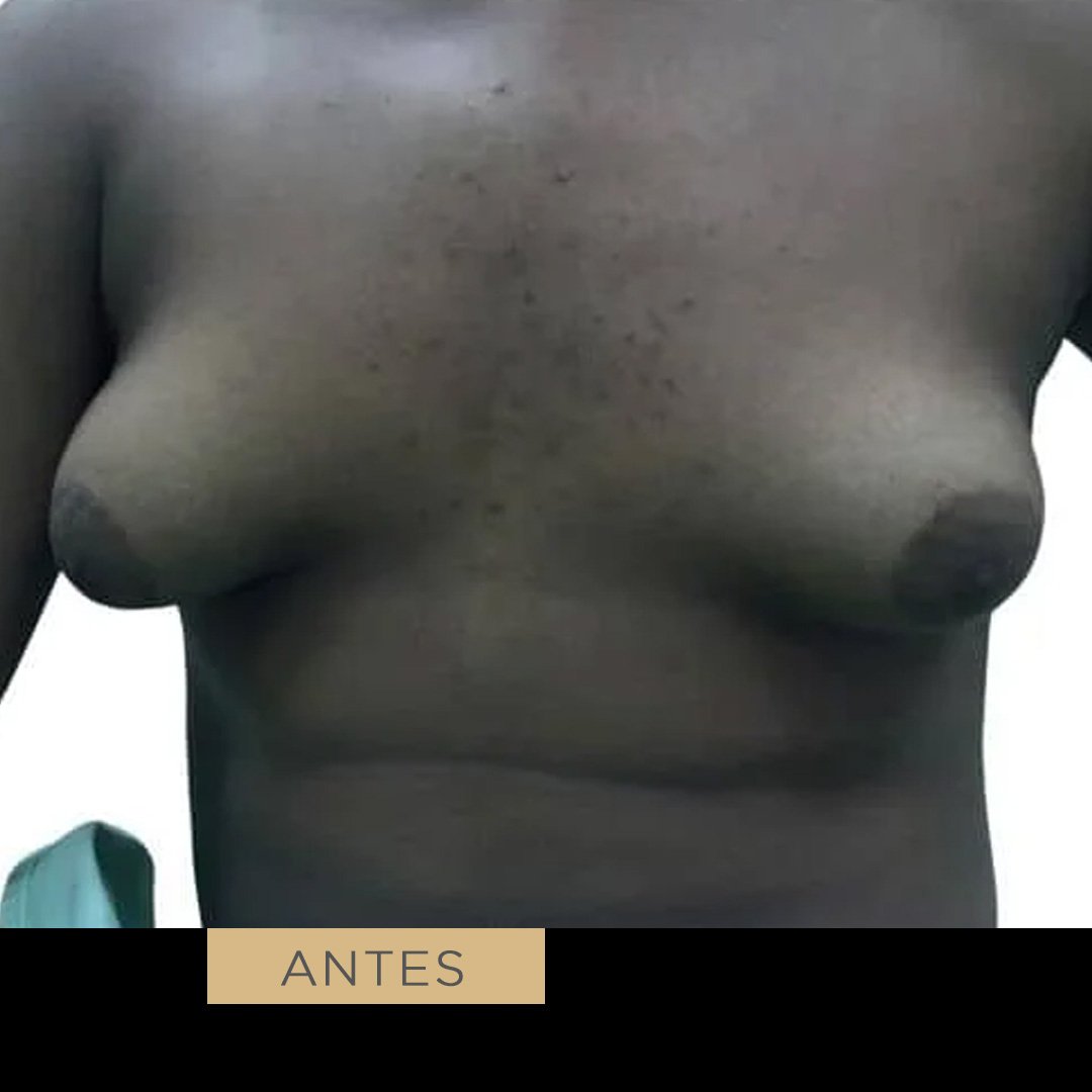 Fotos de Ginecomastia antes 1