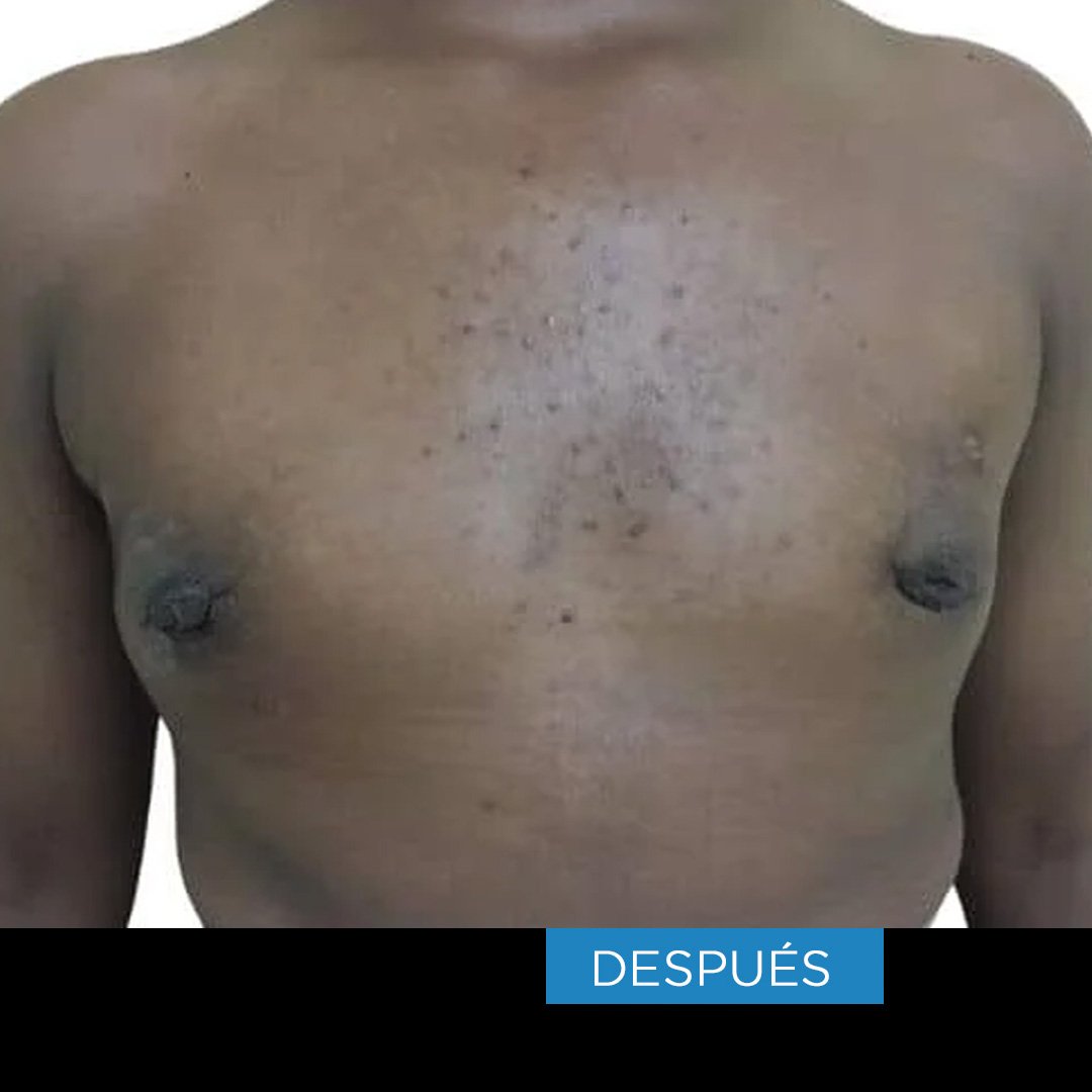 Fotos de Ginecomastia despues 1