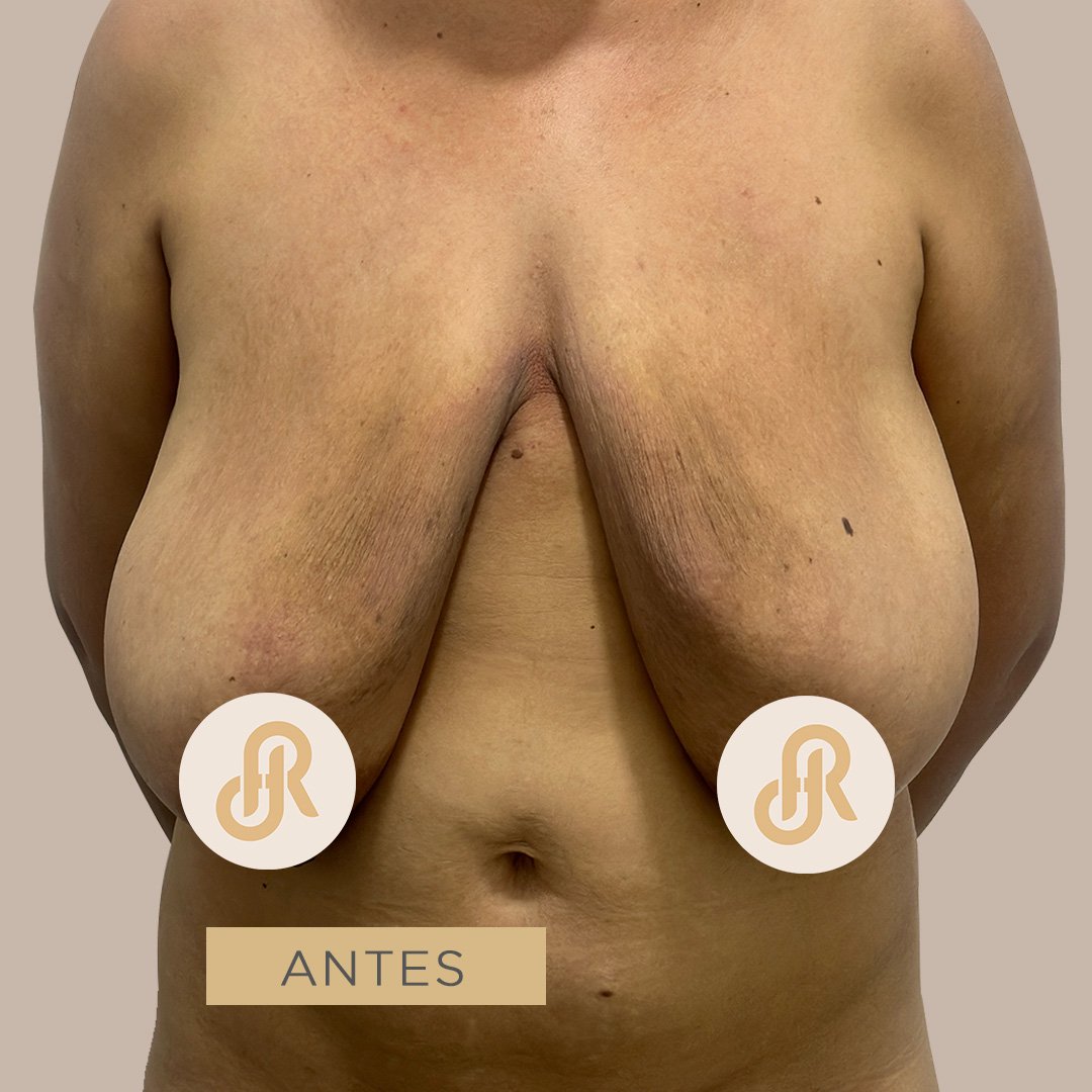 Fotos de Levantamiento de Senos antes