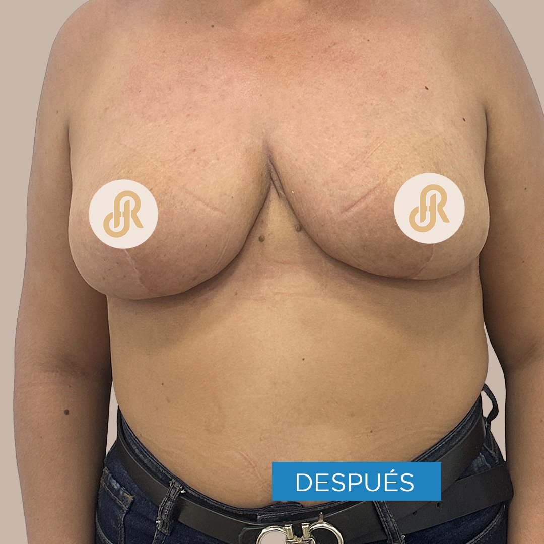 Fotos de Levantamiento de Senos después