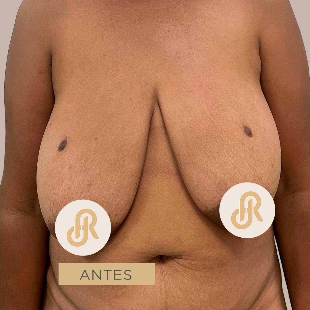 Fotos de Levantamiento de Senos antes 2