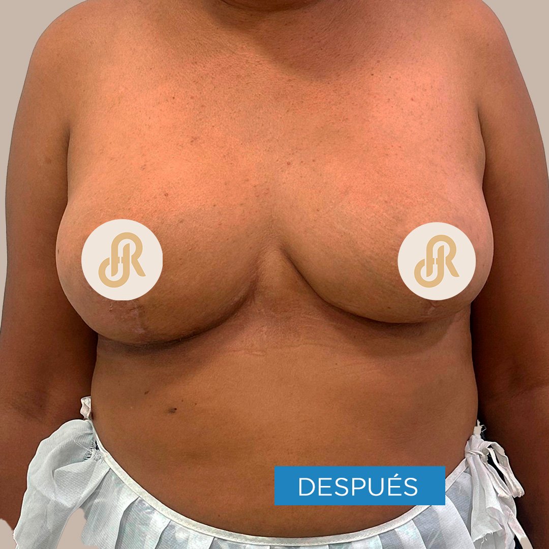 Fotos de Levantamiento de Senos después 2