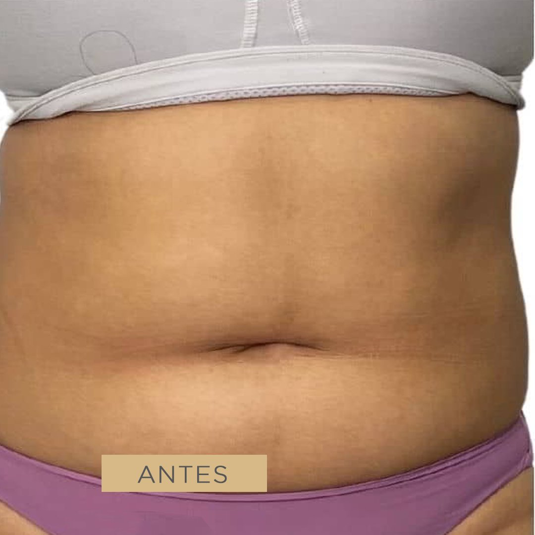 Fotos de liposucción y lipoescultura antes