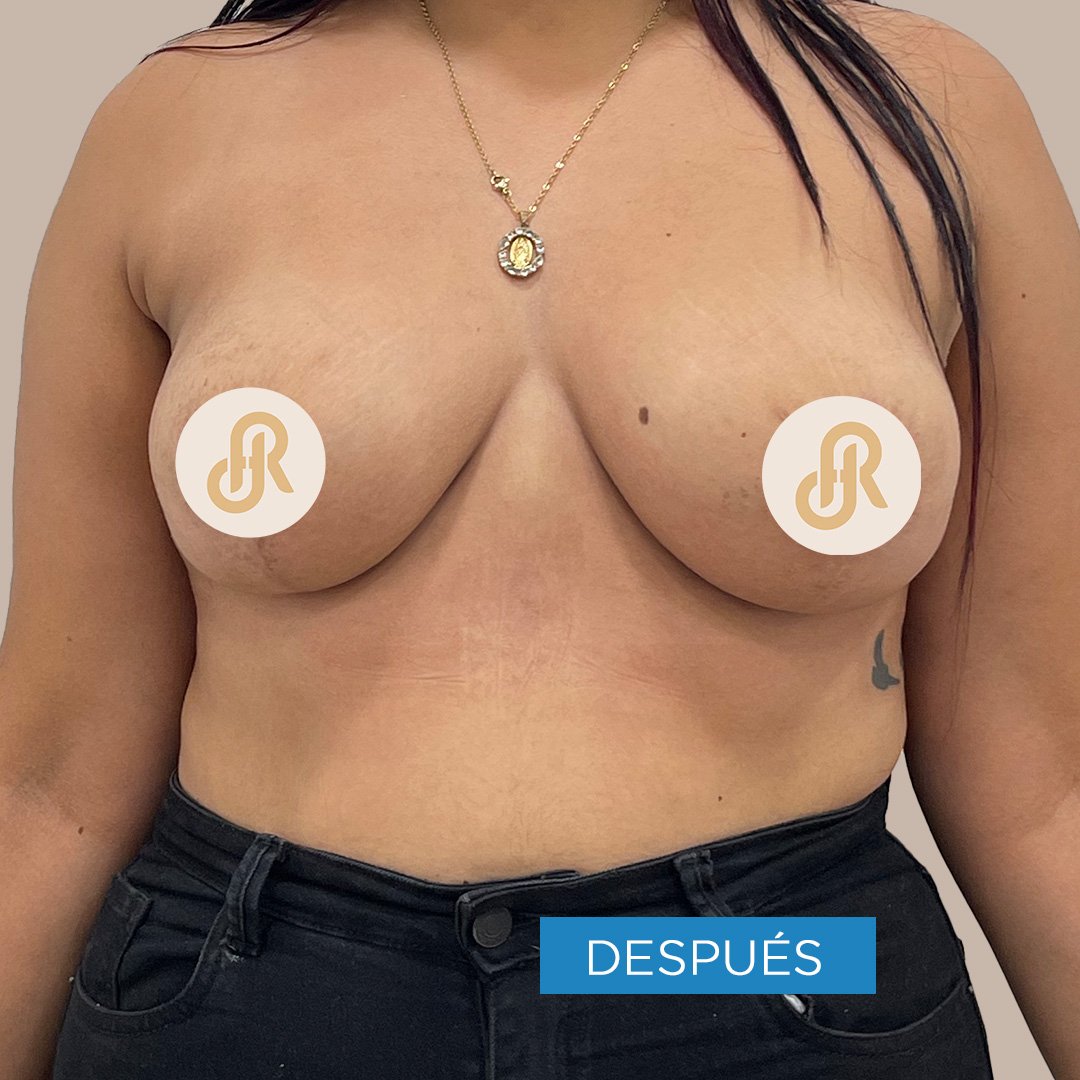 Fotos de Reducción de Senos después