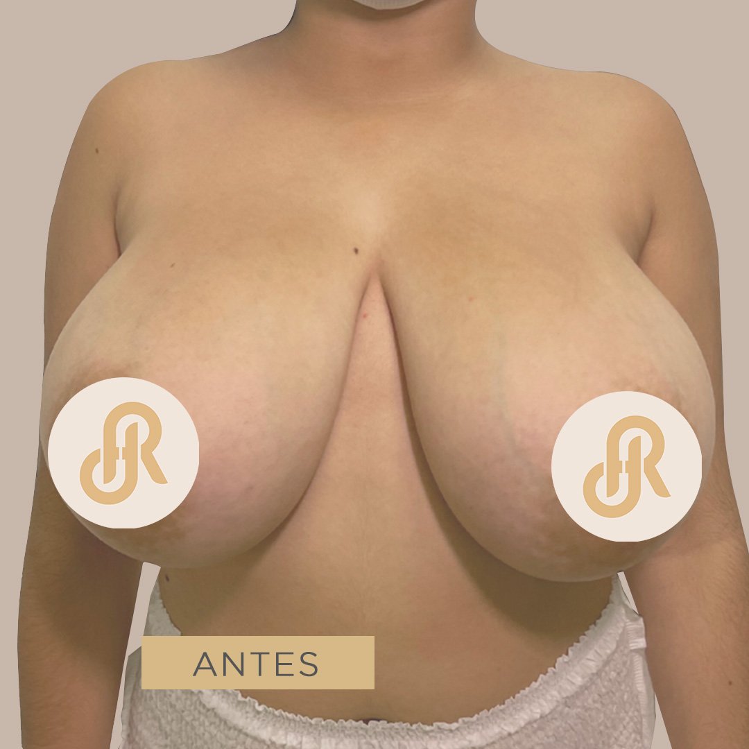 Fotos de Reducción de Senos antes 2