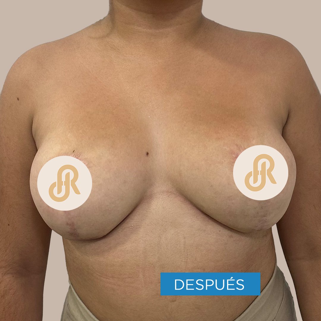 Fotos de Reducción de Senos después 2