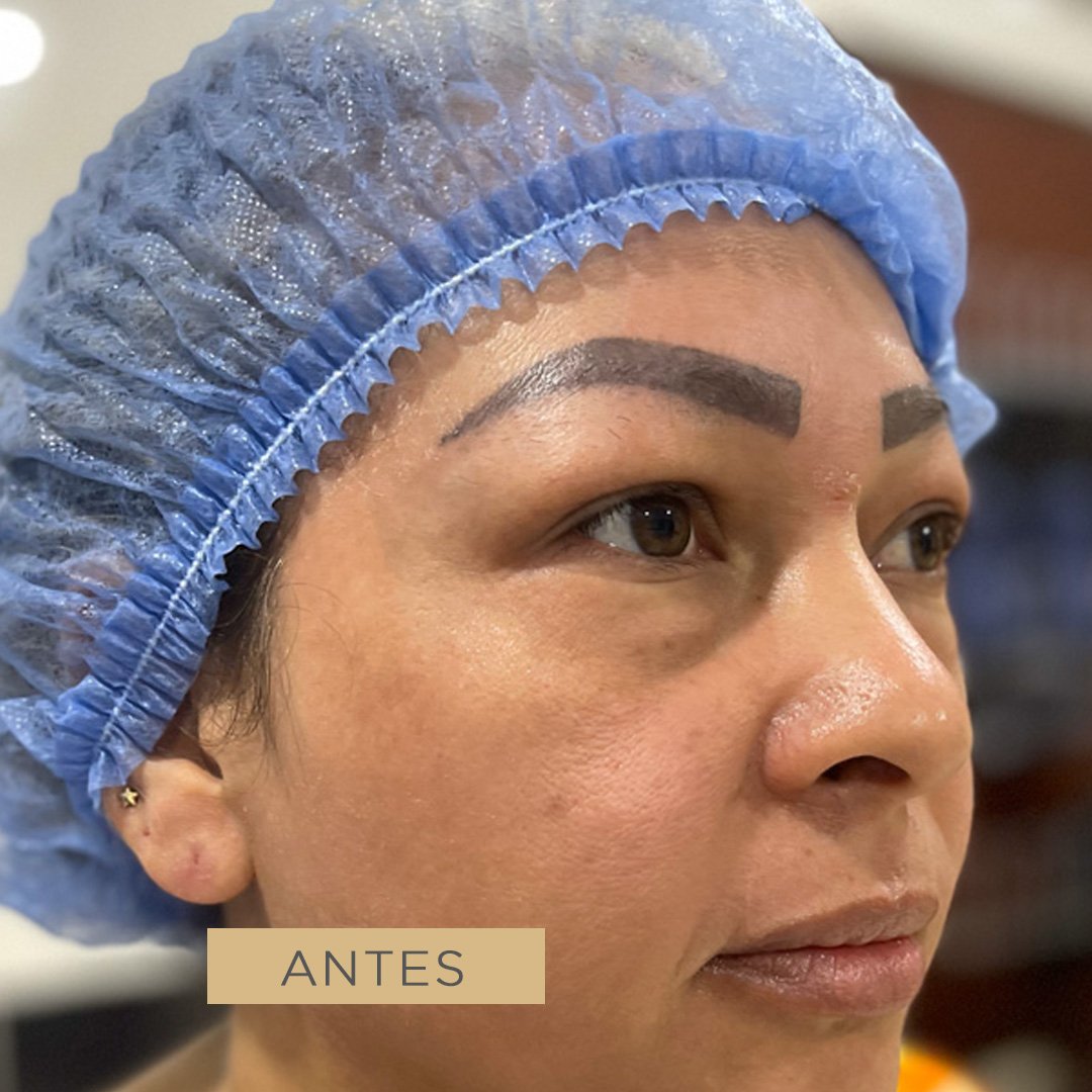 Fotos de Blefaroplastia antes 2