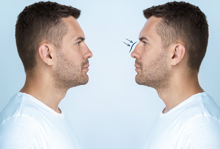 Rinoplastia Dra Damaris Romero