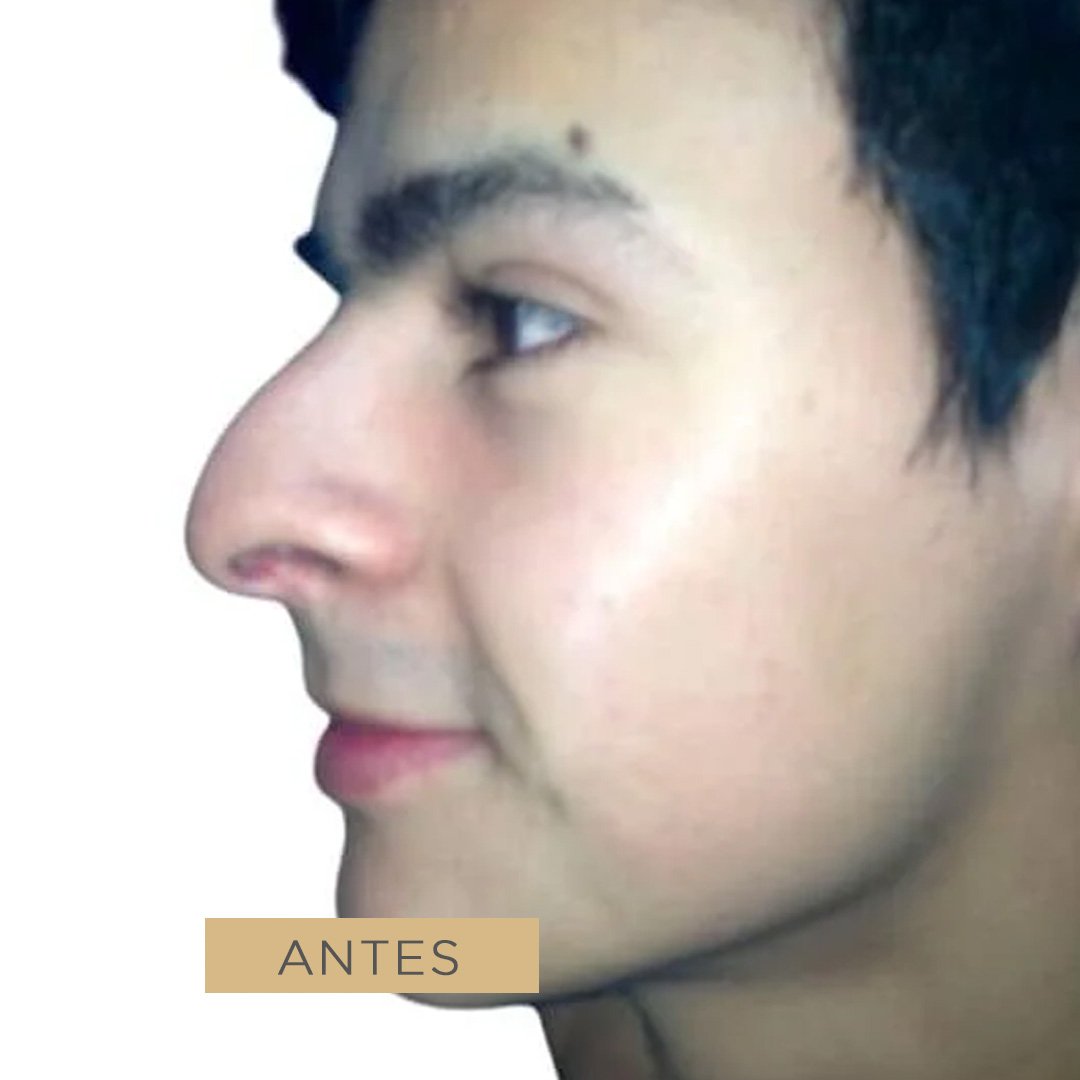 Fotos de Rinoplastia antes 1