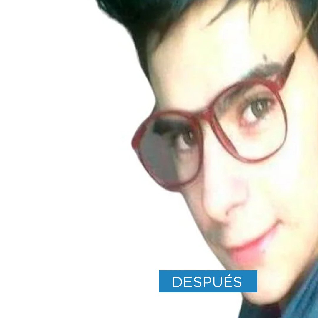 Fotos de Rinoplastia después 1