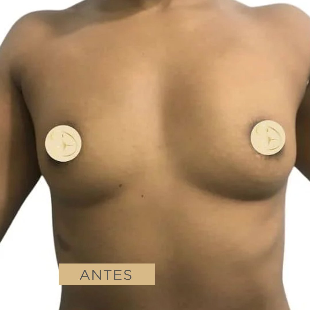 Fotos de Aumento de Senos antes 2