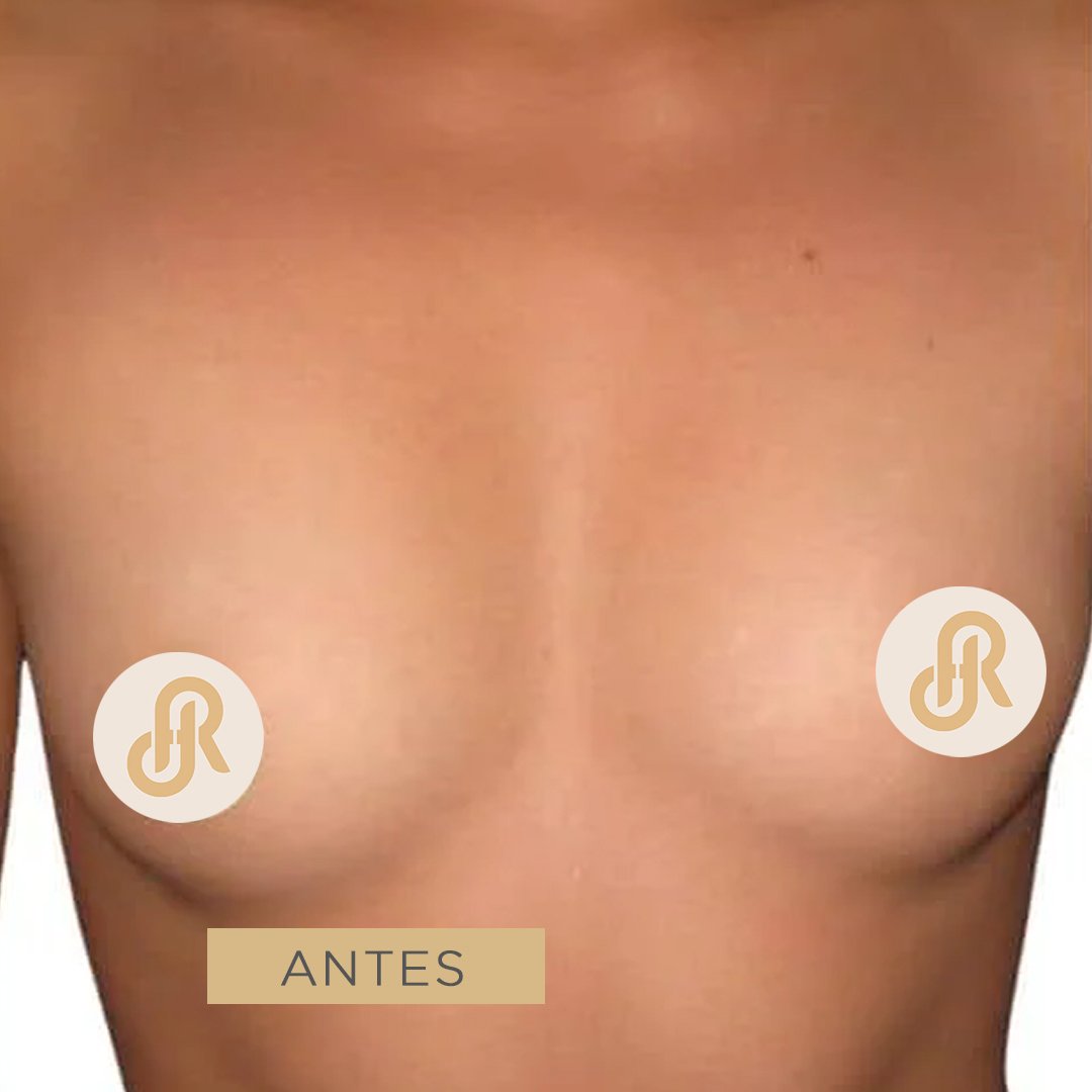 Fotos de Aumento de Senos antes 3