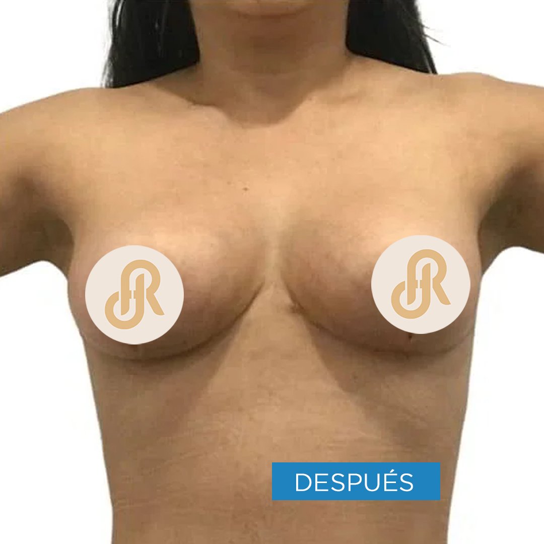 Fotos de Retiro o Explantación de Implantes Mamarios después 2