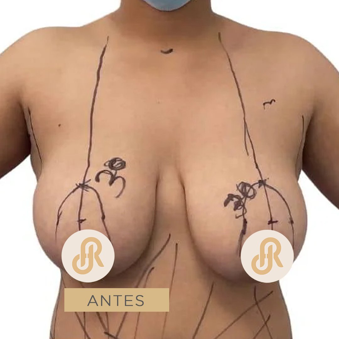 Fotos de Levantamiento de Senos antes 3
