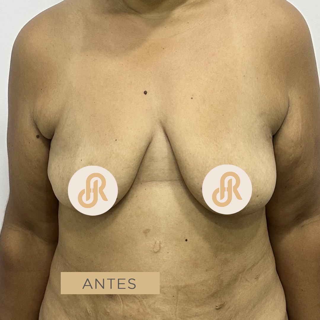 Fotos de Levantamiento de Senos antes 4