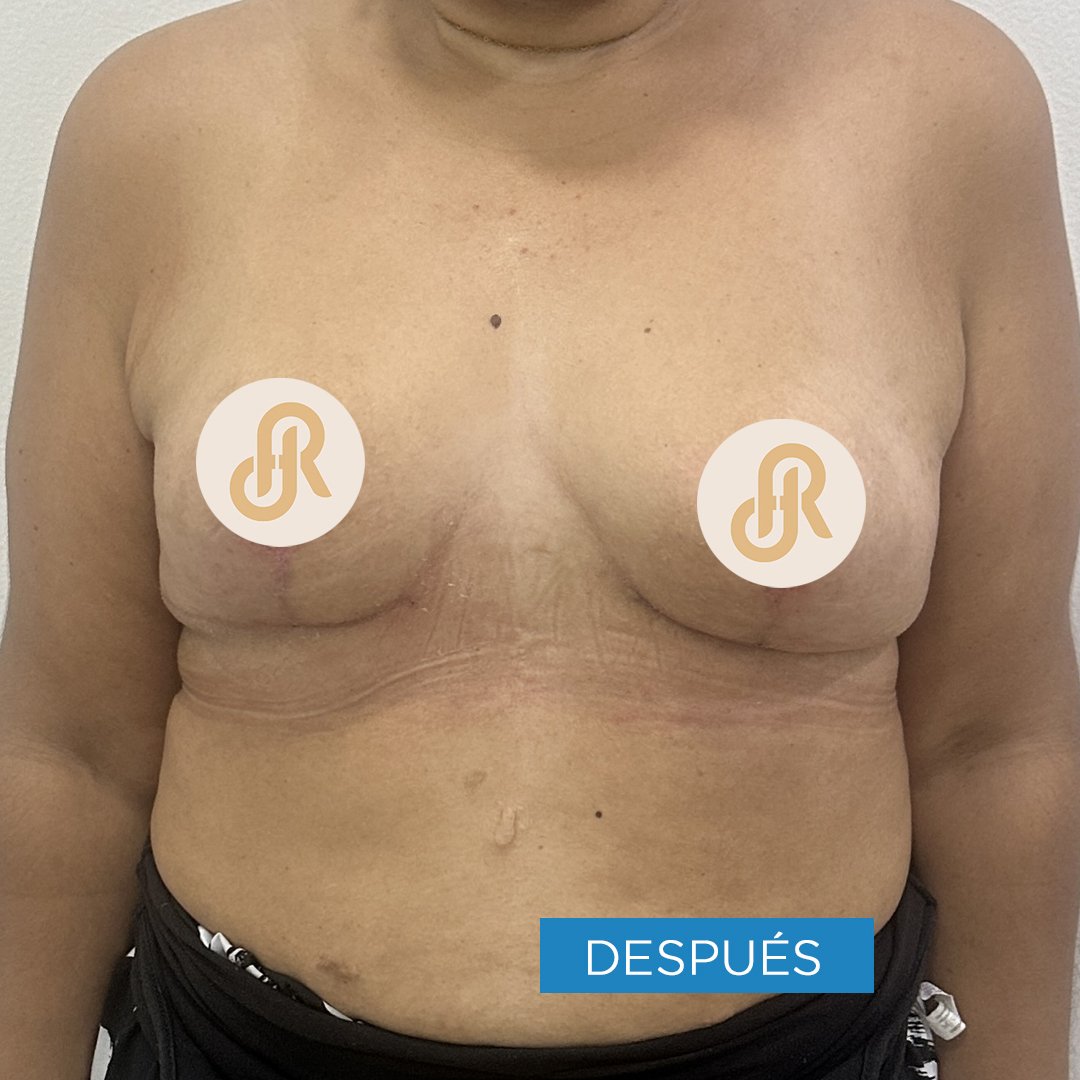 Fotos de Levantamiento de Senos despues 4