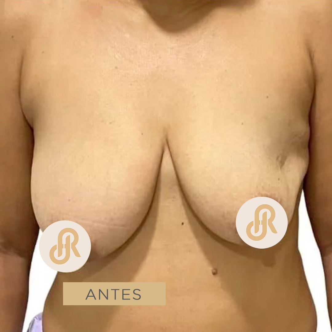 Fotos de Levantamiento de Senos antes 5