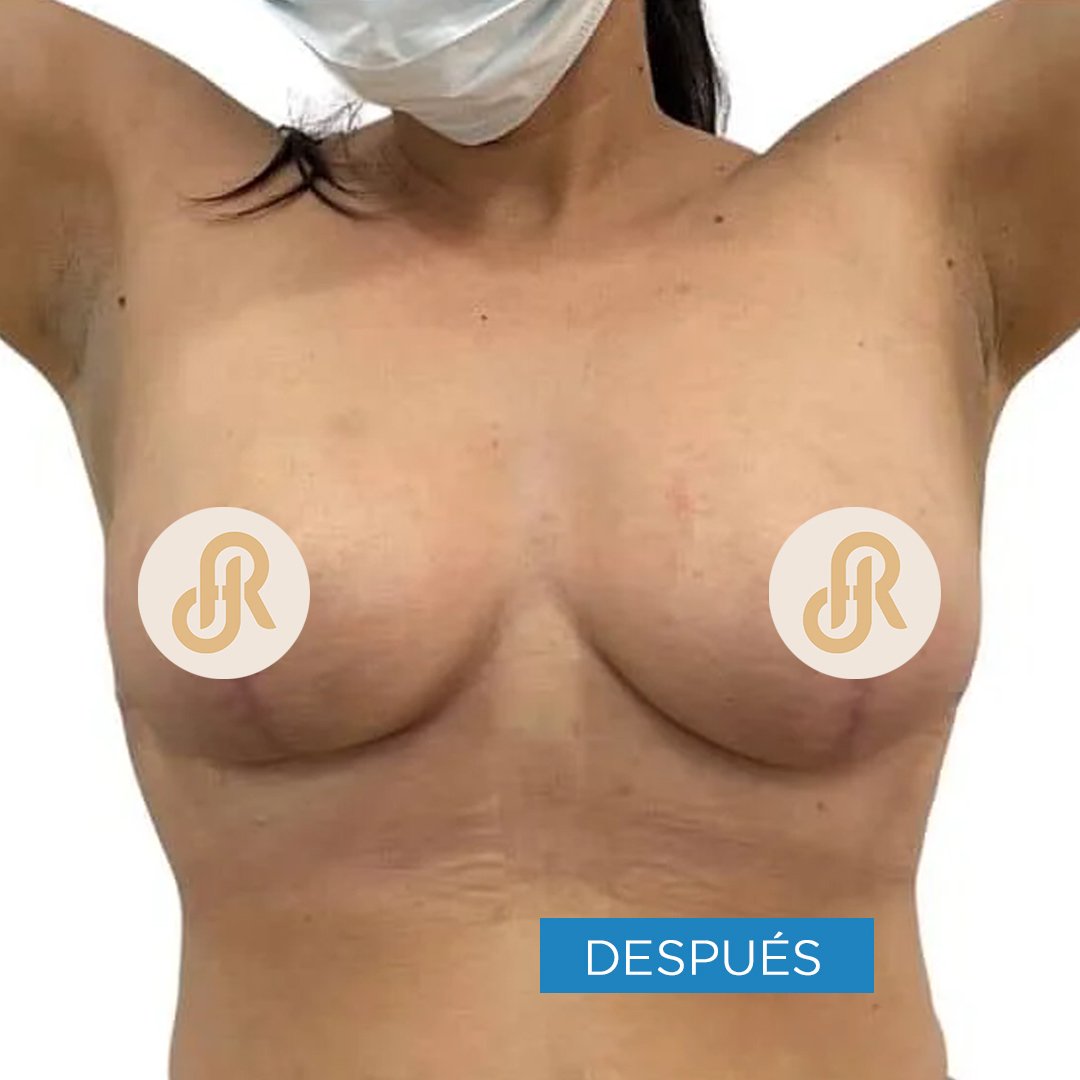 Fotos de Reducción de Senos después 3