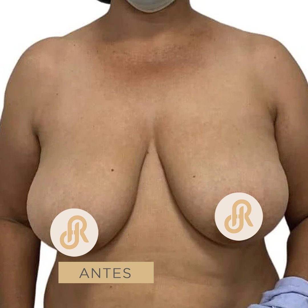 Fotos de Reducción de Senos antes 4