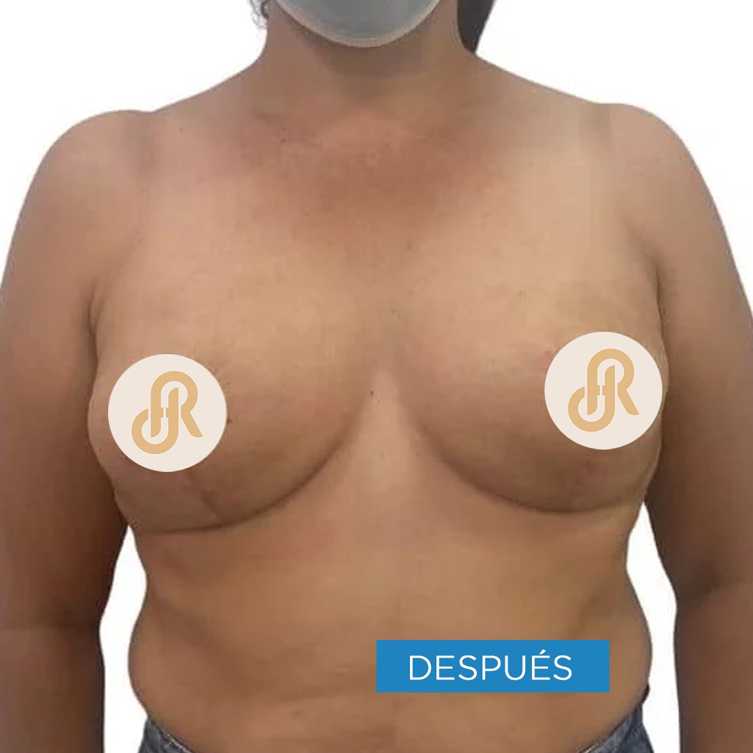 Fotos de Reducción de Senos después 3