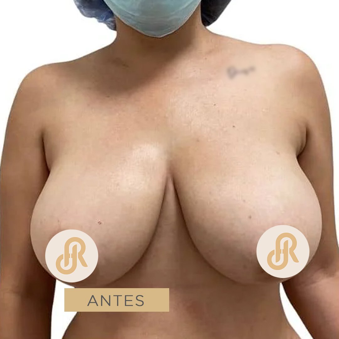 Fotos de Reducción de Senos antes 5