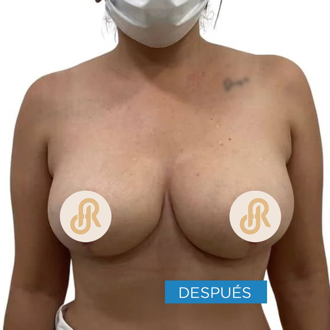 Fotos de Reducción de Senos después 5