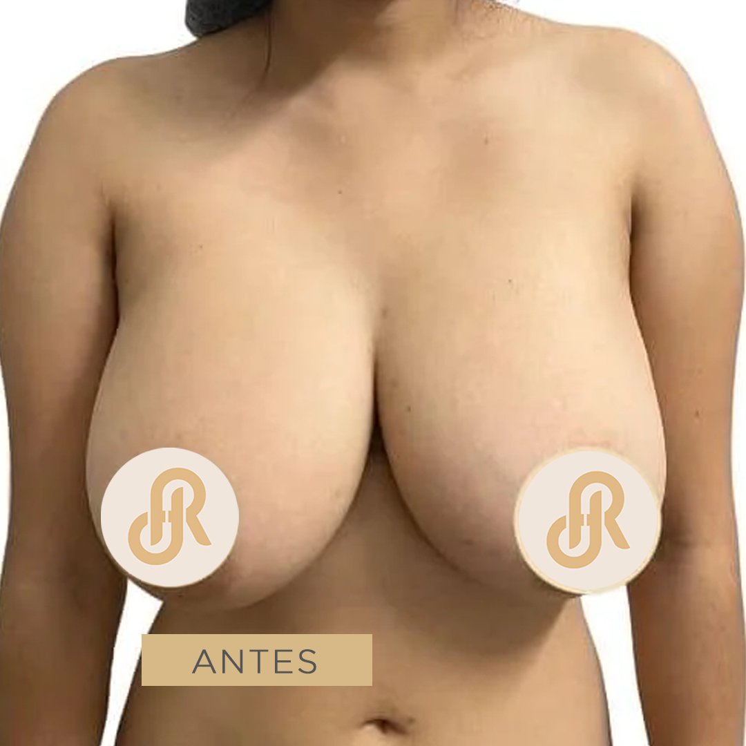 Fotos de Reducción de Senos antes 6