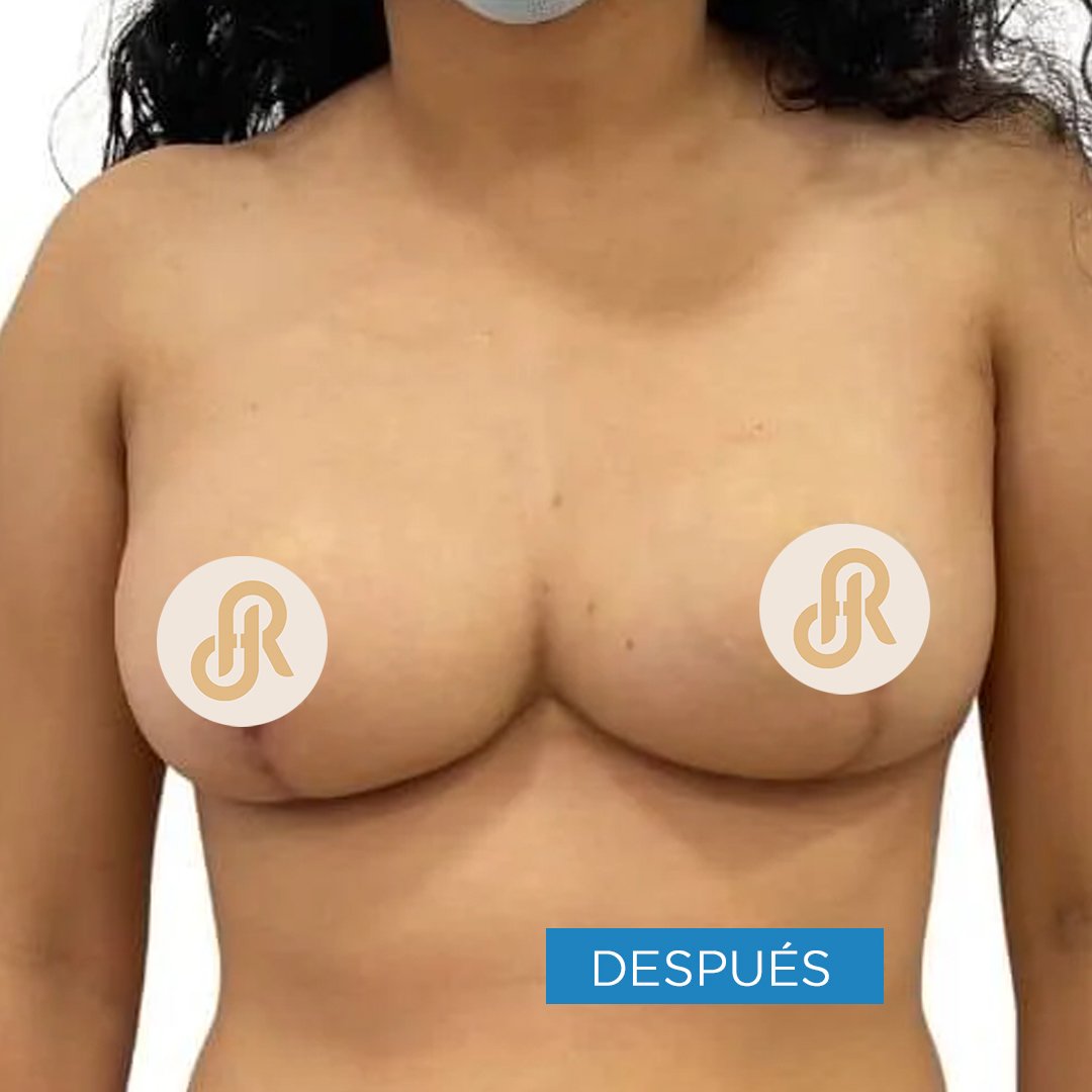 Fotos de Reducción de Senos después 6