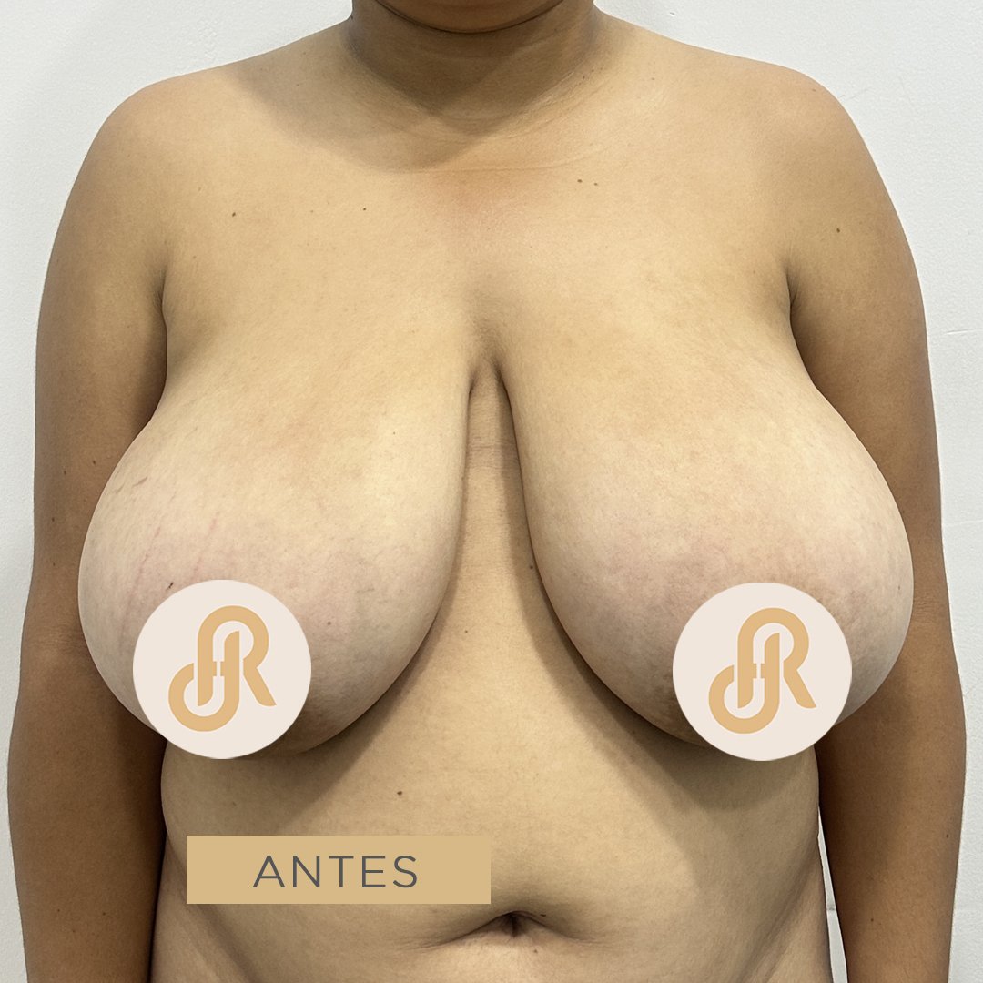 Fotos de Reducción de Senos antes 7