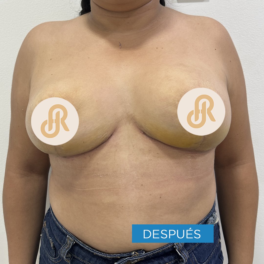 Fotos de Reducción de Senos despues 7