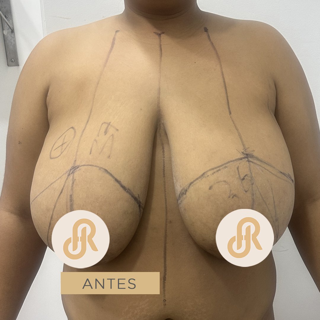 Fotos de Reducción de Senos antes 8