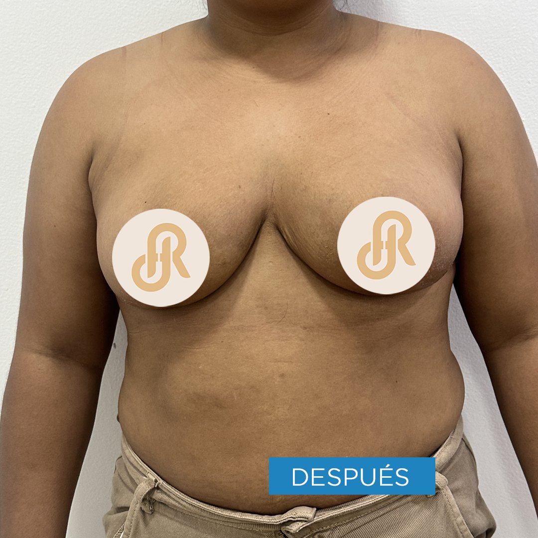 Fotos de Reducción de Senos despues 8