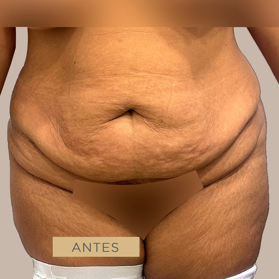 Fotos de Abdominoplastia antes 4