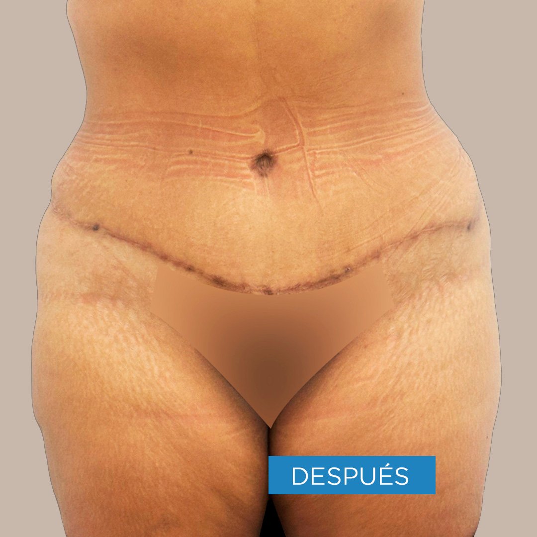 Fotos de Abdominoplastia despues 4