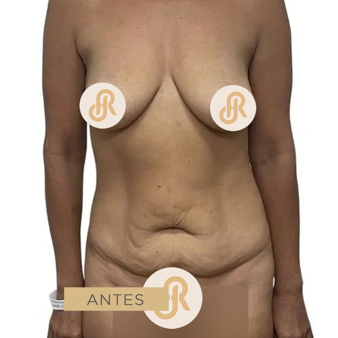 Fotos de Abdominoplastia antes 2