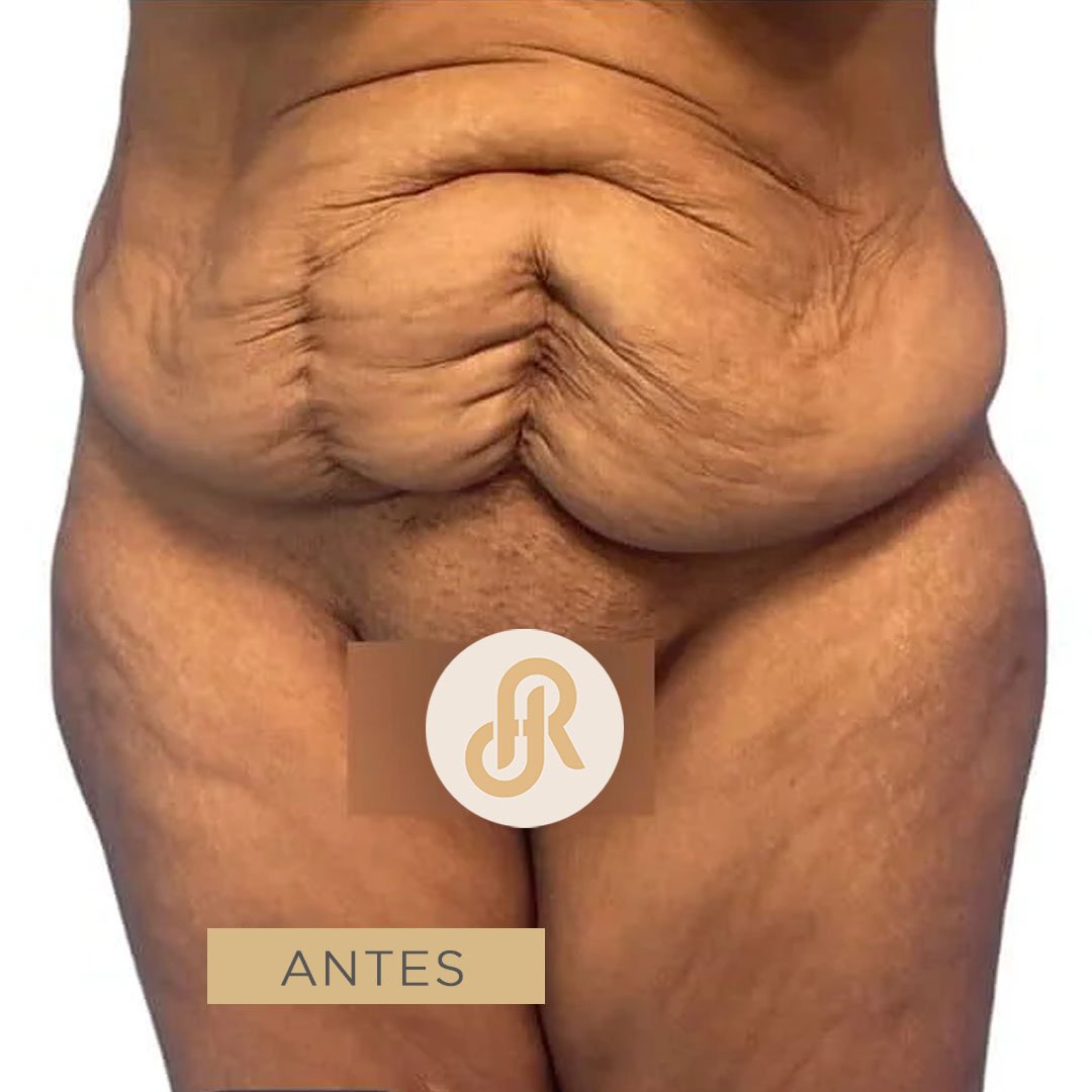 Fotos de Abdominoplastia antes 3