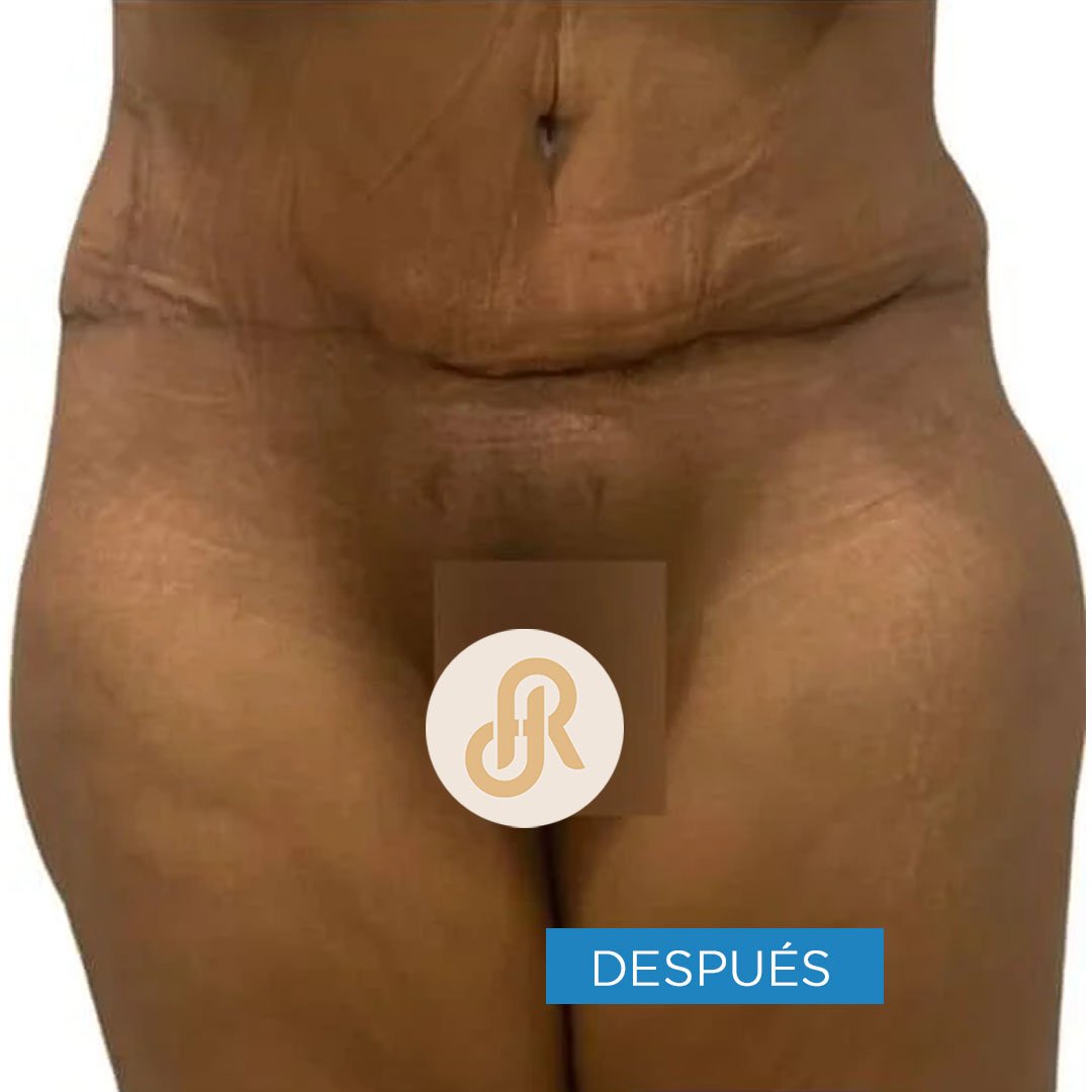 Fotos de Abdominoplastia despues 3