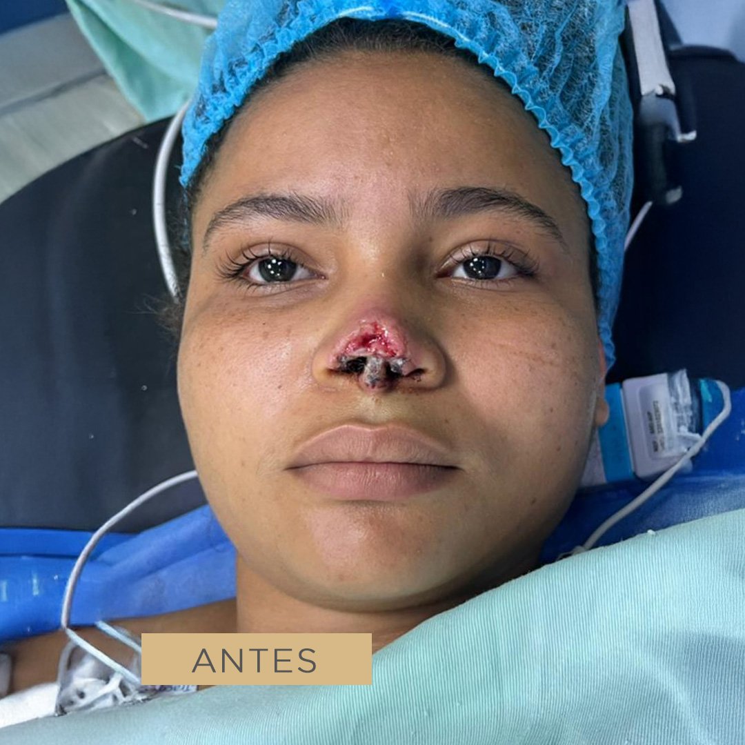 Fotos de Cirugía Reconstructiva antes